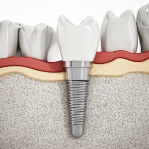 a 3D illustration of a dental implant in the jawbone