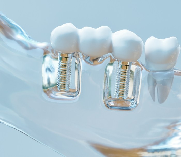 Model of the mouth with two dental implants in Grenada