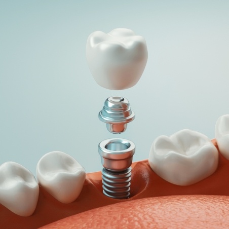 Illustrated dental implant with abutment and crown