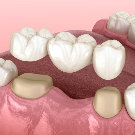 Illustrated dental bridge replacing a missing tooth in Grenada