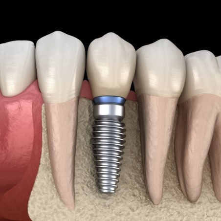 Illustrated dental implant in lower jawbone