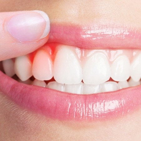 Close up of person pointing to red spot in their gums