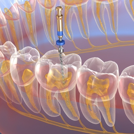 Illustrated dental instrument treating the inside of a tooth